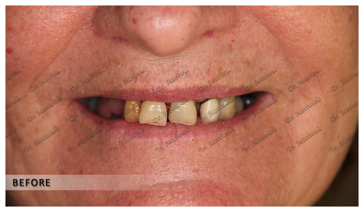 full mouth dental implants before and after