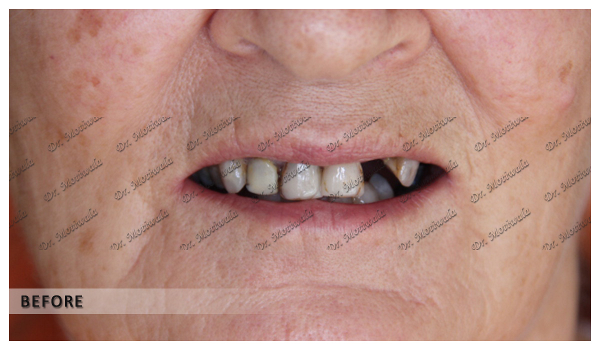 full mouth dental implants before and after