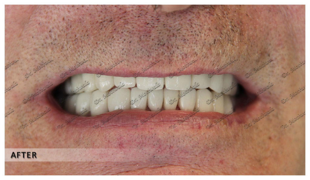 Armpit waxing near me picture