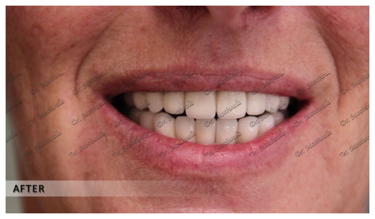 full mouth dental implants before and after