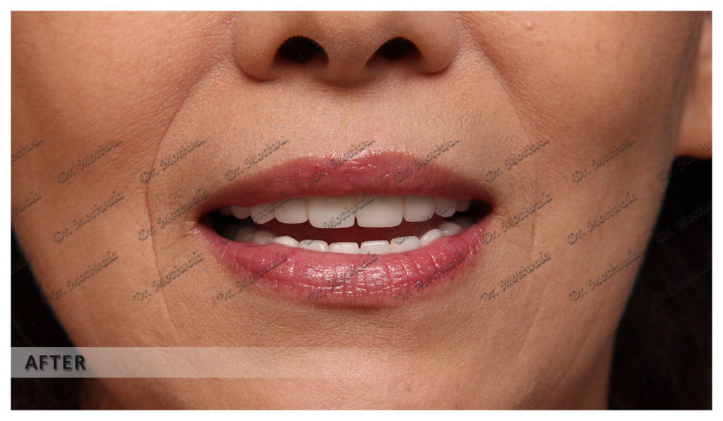 Case study implants picture