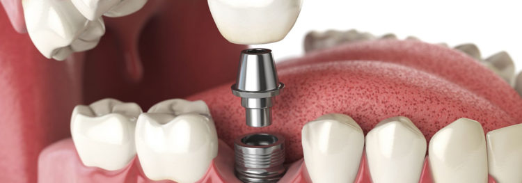 Full mouth Dental Implants