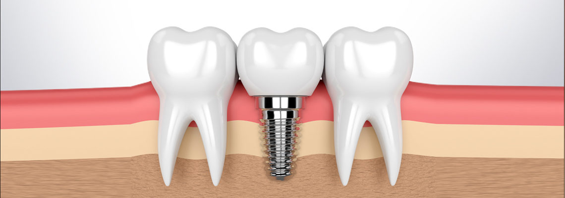 Basal dental implants cost