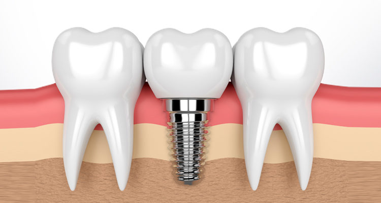 basal implants in Hyderabad