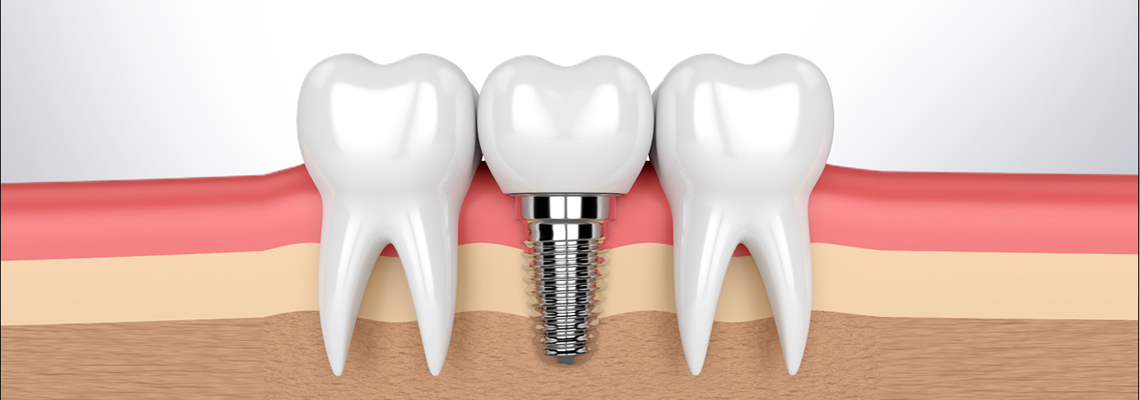 basal implants in Hyderabad