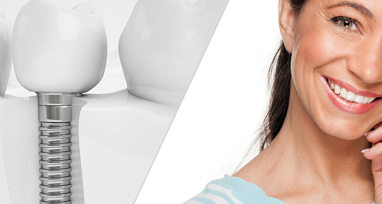 affordable dental implants in hyderabad