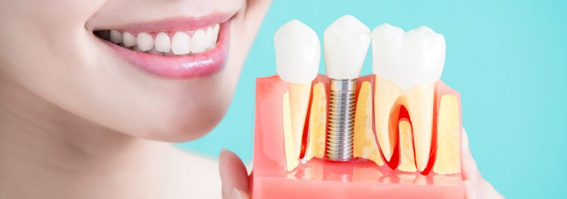affordable dental implant