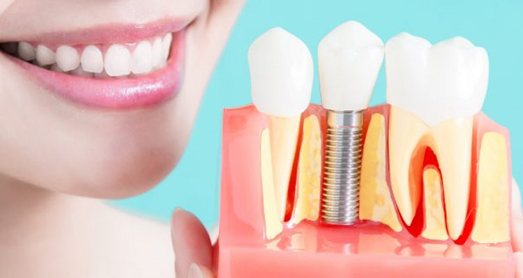 affordable dental implant