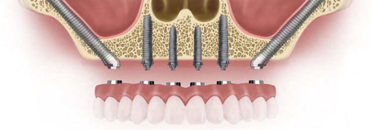 zygomatic implants cost