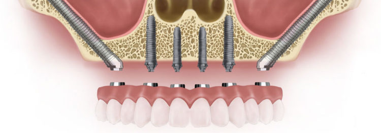 zygomatic implants cost