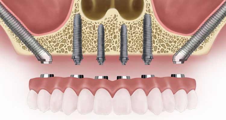 zygomatic implants cost