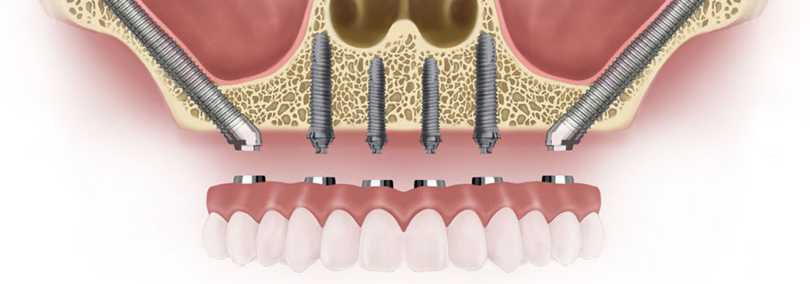 zygomatic implants cost