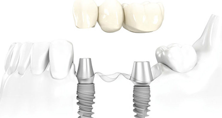 dental implant cost