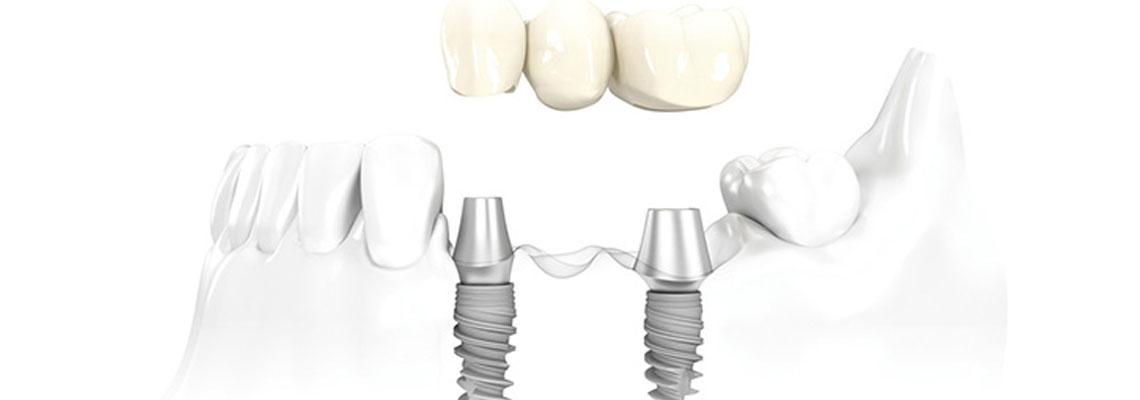 dental implant cost