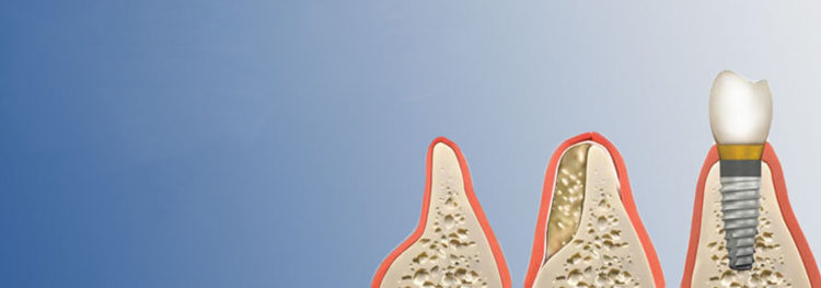 dental bone graft cost