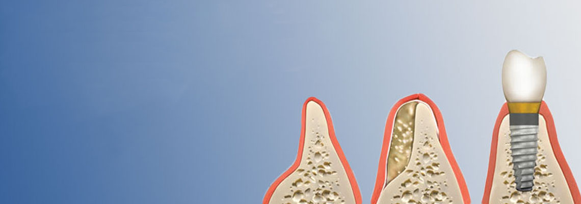 dental bone graft cost