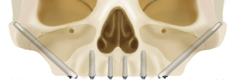 benefits of zygomatic implants