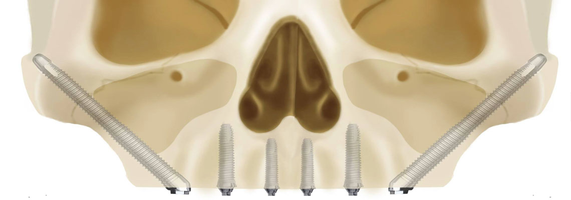 benefits of zygomatic implants