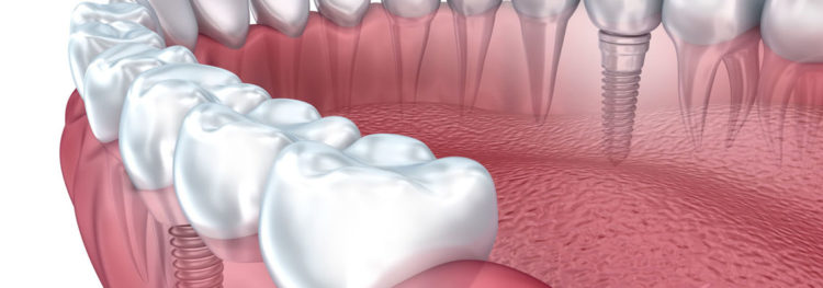 tooth implant cost in India