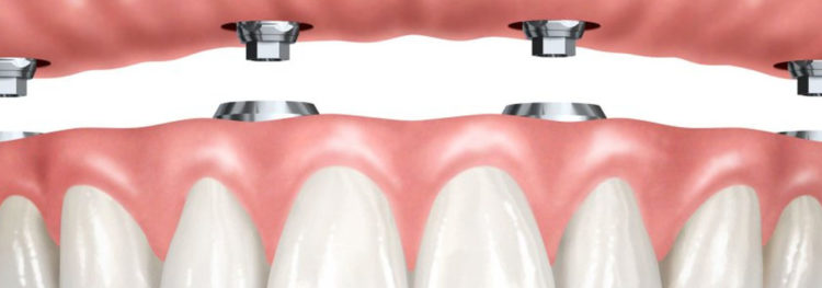 low-cost dental implants Florida