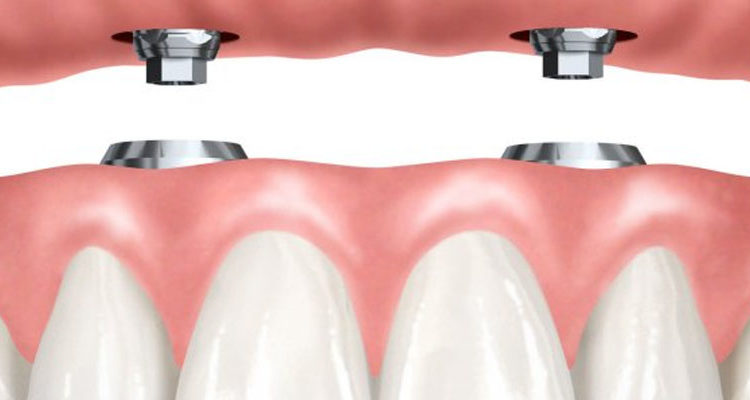 low-cost dental implants Florida