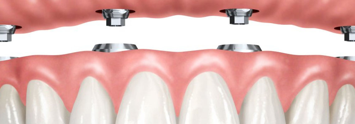 low-cost dental implants Florida