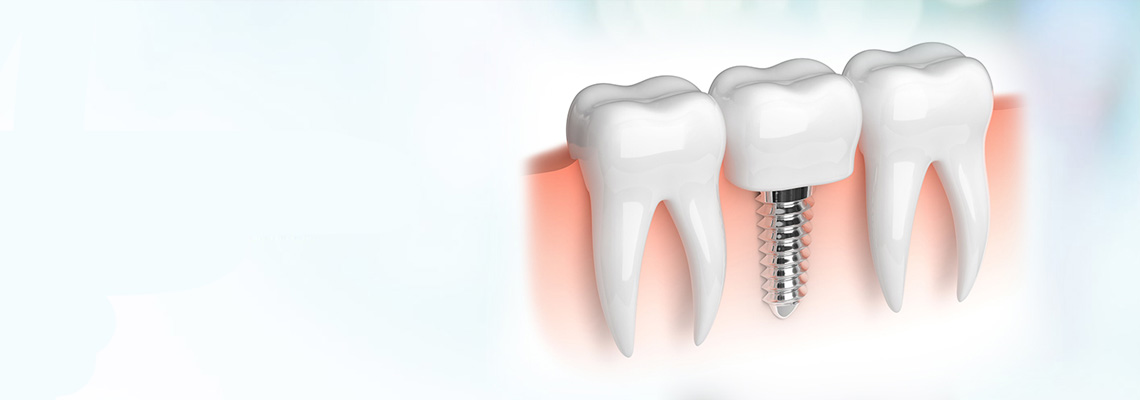 Basal Implants in Hyderabad