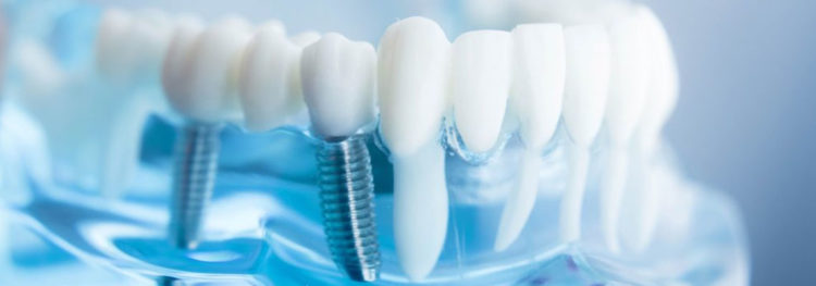 dental implants in Hyderabad