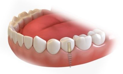 FULL MOUTH DENTAL IMPLANTS COST Single Tooth Implant