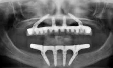 FULL MOUTH DENTAL IMPLANTS COST BY NUMBER OF IMPLANTS PER ARCH All on 4