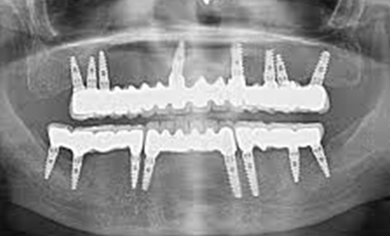 FULL MOUTH DENTAL IMPLANTS COST BY NUMBER OF IMPLANTS PER ARCH Fixed Bridge All on 8