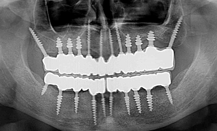 FULL MOUTH DENTAL IMPLANTS COST BY NUMBER OF IMPLANTS PER ARCH Permanent teeth in 3 days