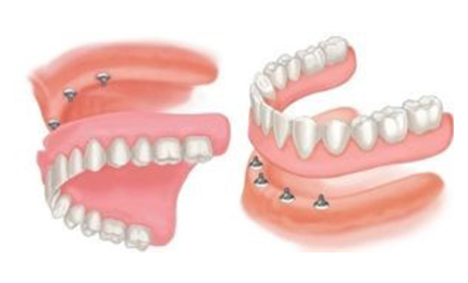 Full mouth dental implants cost implant dentures with 4 dental implants per arch