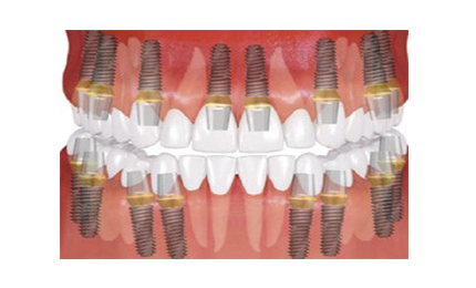 FULL MOUTH DENTAL IMPLANTS COST All on 8 with 16 dental implants full mouth