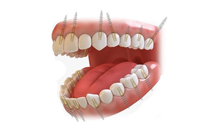 FULL MOUTH DENTAL IMPLANTS COST Permanent teeth in 3 days