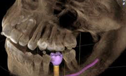 Additional dental implant cost india vs us 3d x-ray to diagnose and plan your treatment