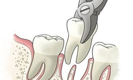 Additional dental implant cost india vs us cost to extract bad teeth