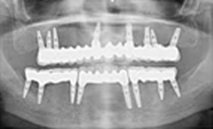 ADDITIONAL DENTAL IMPLANT COST INDIA VS US initial dental implant consultation