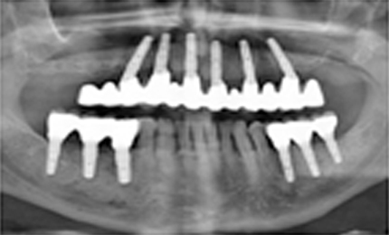 ADDITIONAL DENTAL IMPLANT COST INDIA VS US initial dental implant consultation