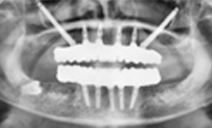 ADDITIONAL DENTAL IMPLANT COST INDIA VS US initial dental implant consultation