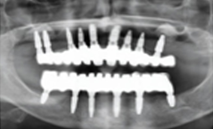 ADDITIONAL DENTAL IMPLANT COST INDIA VS US initial dental implant consultation