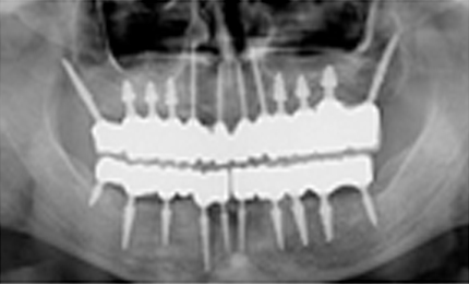 ADDITIONAL DENTAL IMPLANT COST INDIA VS US initial dental implant consultation