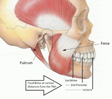 Pterygoid Implant Procedure & Cost