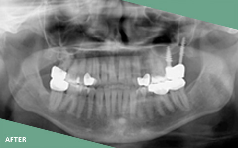 Pterygoid Implant Procedure & Cost