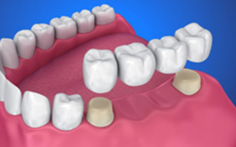 Bridges on Teeth