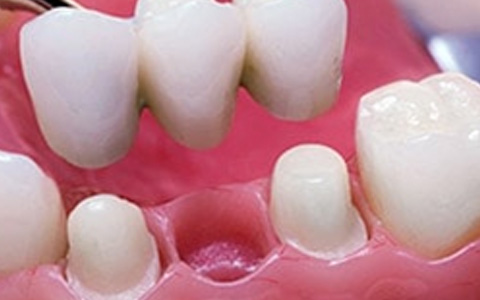 Bridges on Teeth