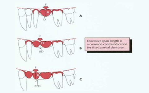 Bridges on Teeth