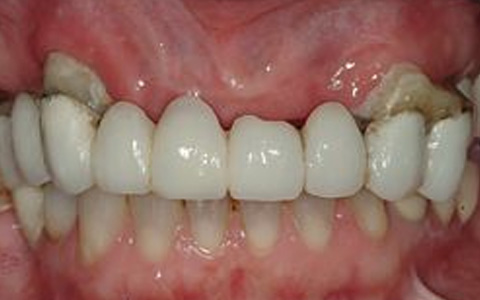 Bridges on Teeth