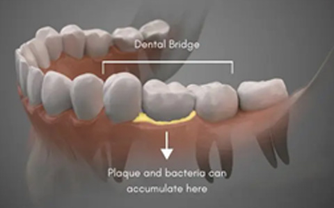 Bridges on Teeth