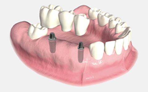 Implant-Supported Bridges